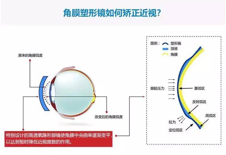 治近视眼最好的方法