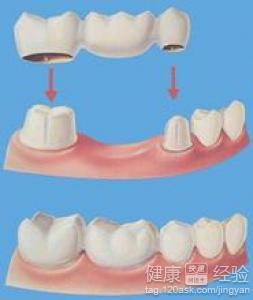 补牙后注意事项 吃饭
